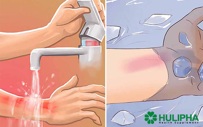 Các Biện Pháp Khắc Phục Vết Bỏng Tại Nhà